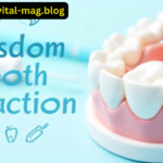 Wisdom Tooth Extraction Infection